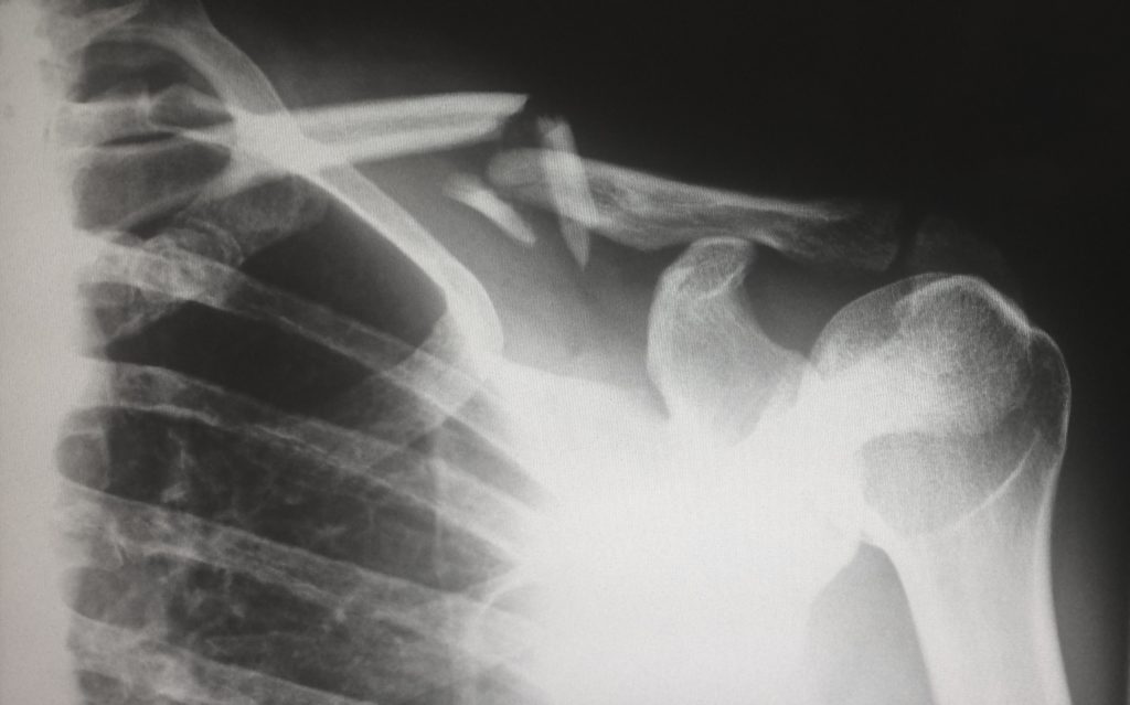 X ray of broken collar bone