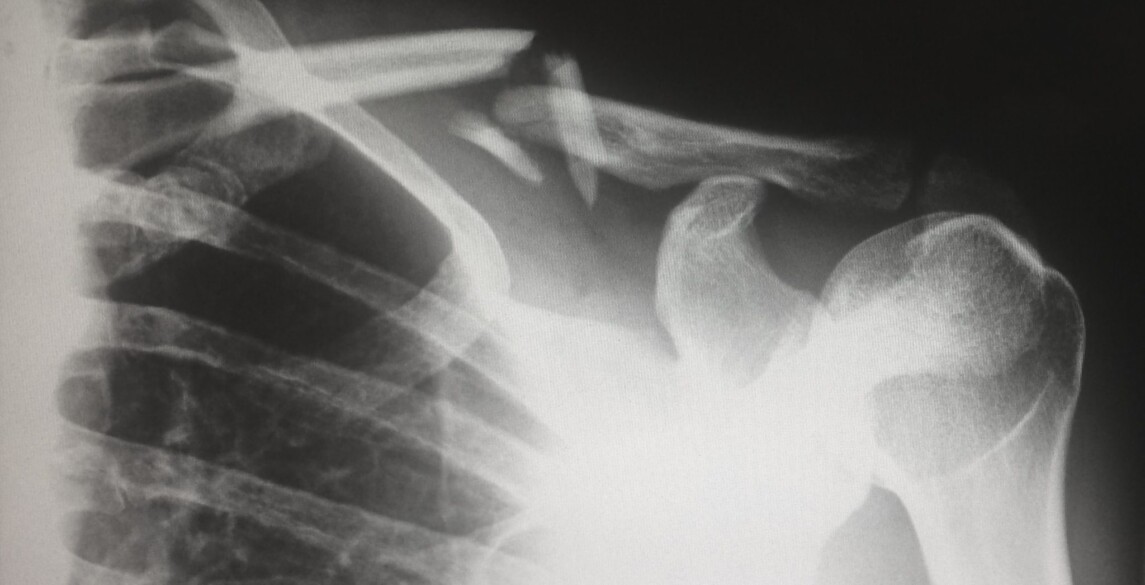 X ray of broken collar bone