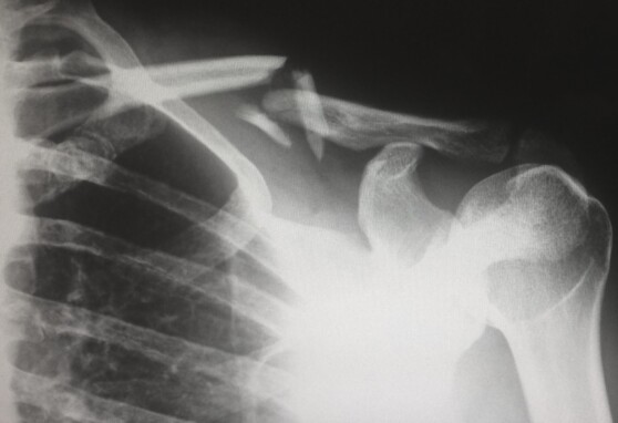 X ray of broken collar bone